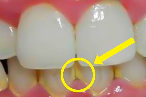 Зубной налет исчезнет спустя 5 минут! Отменила поход к стоматологу.