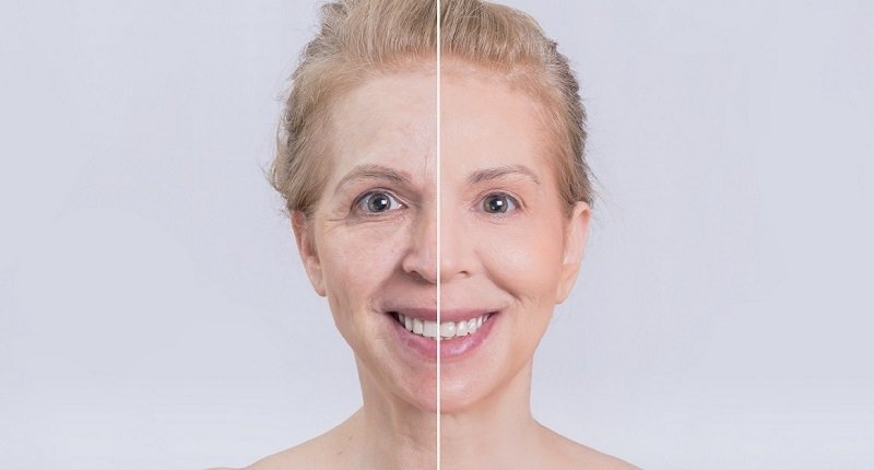 дряблая кожа