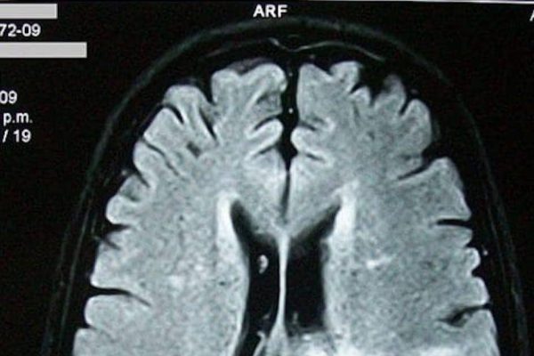 Моя родственница стала жаловаться на плохую память и рассеянность. Вот что ей сказал молодой невропатолог!