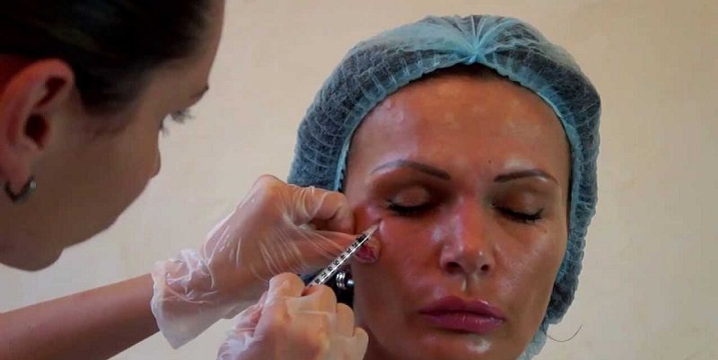 уколы ботокса