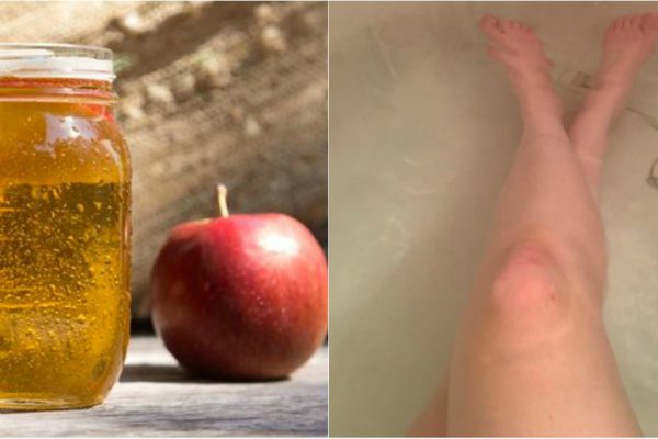 Она набрала ванну и добавила 500 мл яблочного уксуса. Через 30 минут ее кожу было не узнать!