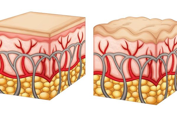 Diagram showing normal skin tissue and skin tissue with cellulite