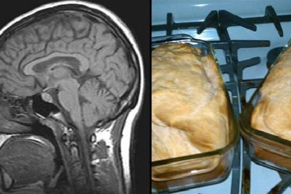 Осторожно — болезнь Альцгеймера! Вот какие продукты сохранят молодость мозга.