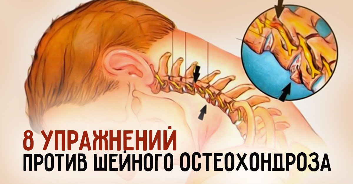 Что делать при остеохондрозе. Разрыв шейного позвонка. Упражнения против головокружений при шейном остеохондрозе. Упражнения от хондроза шеи. Разрыв связок шейного отдела.