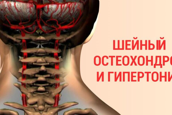 90 % трудоспособного населения страдает от шейного остеохондроза… Останови этот замкнутый круг!