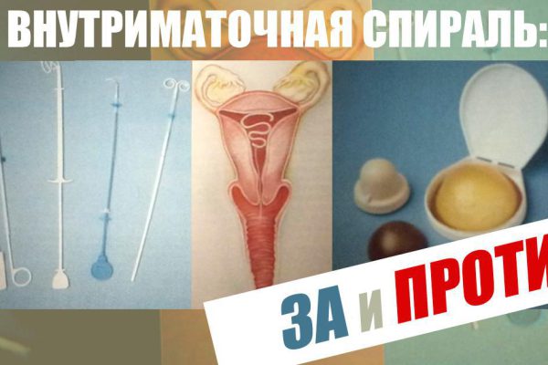 Очень личная тема, мои впечатления об этом изделии! ВМС: советуют несколько вариантов. Гормональные, с серебром, медью…