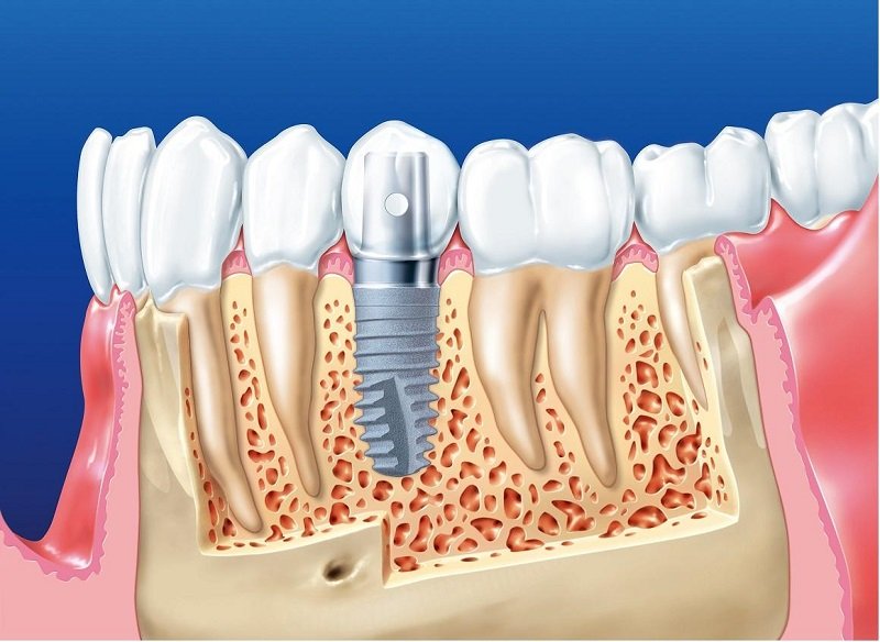 противопоказания к установке зубных имплантов