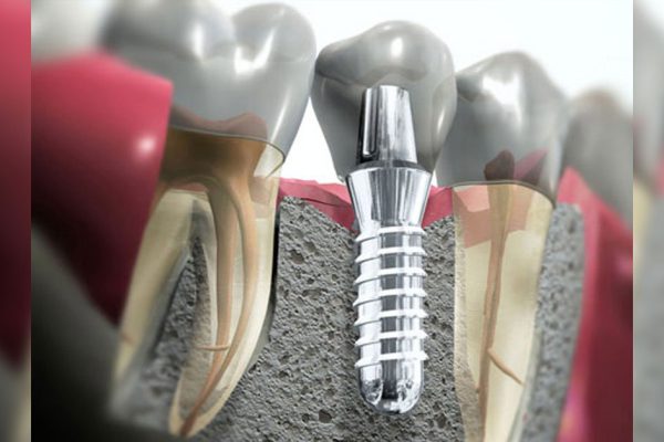 Что лучше — штифт или имплант? Все подводные камни имплантации зубов! Есть адские минусы…