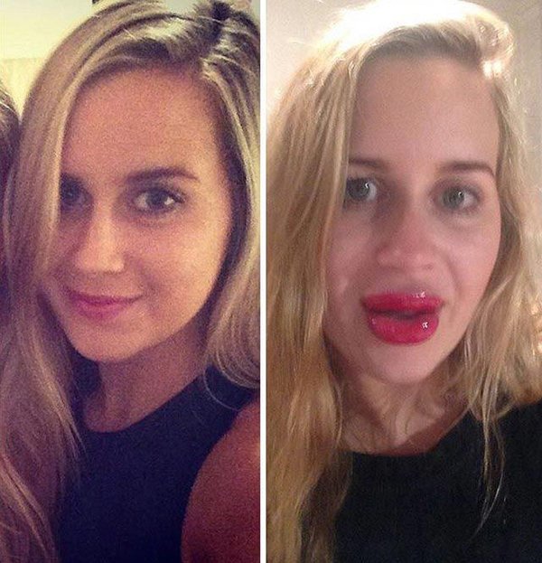 увеличение губ