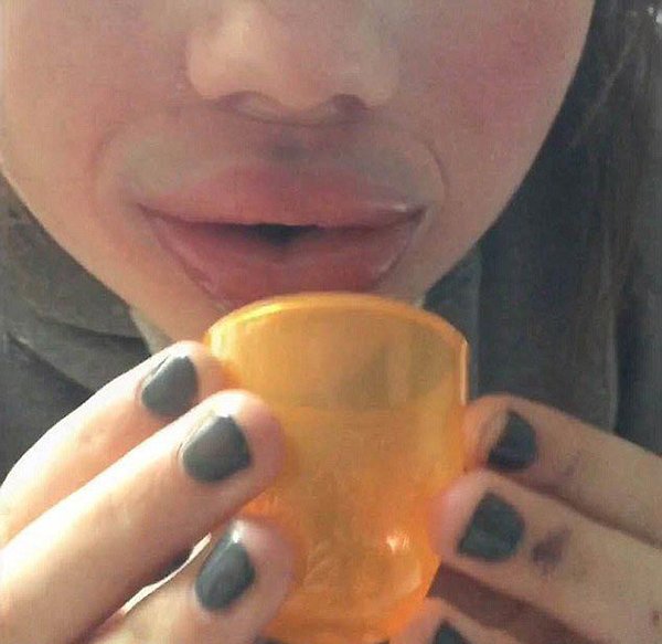 увеличение губ