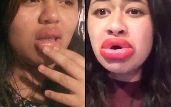 увеличение губ