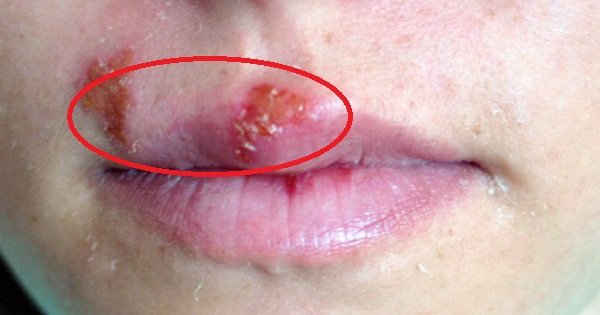 Вирус герпеса — не просто легкая кожная болезнь. На самом деле он опаснее, чем ты думал!