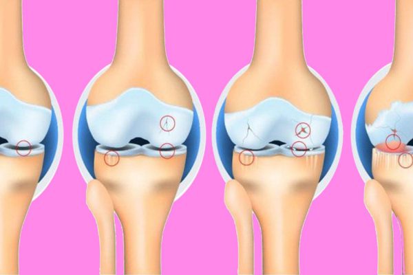 Если хрящ истончается, то кости практически трутся одна о другую! Избавиться от боли можно с помощью…
