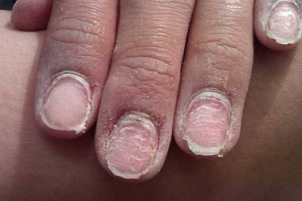 Чем грозит гель-лак вашим ногтям, красавицы! Прочесть обязательно.