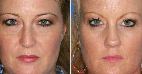 Фотографии близнецов, один из которых курил! Результат налицо.