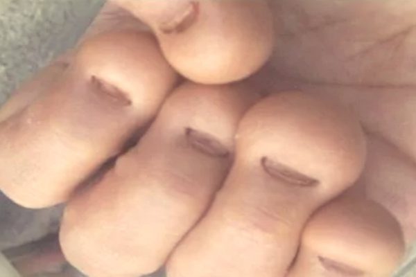 Почему нельзя грызть ногти: 9 последствий вредной привычки.