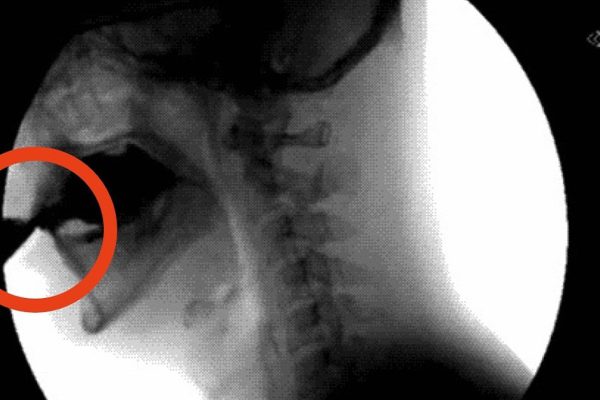Этот яд разрушает наши кости! Но некоторые пьют его каждый день.