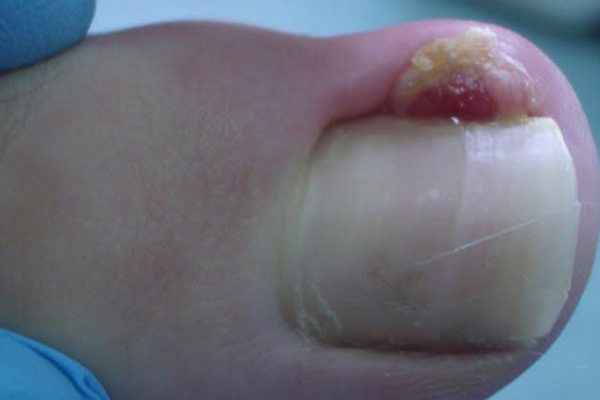 Осторожно, это заболевание может привести к ампутации пальца! Узнай всю правду о вросшем ногте.