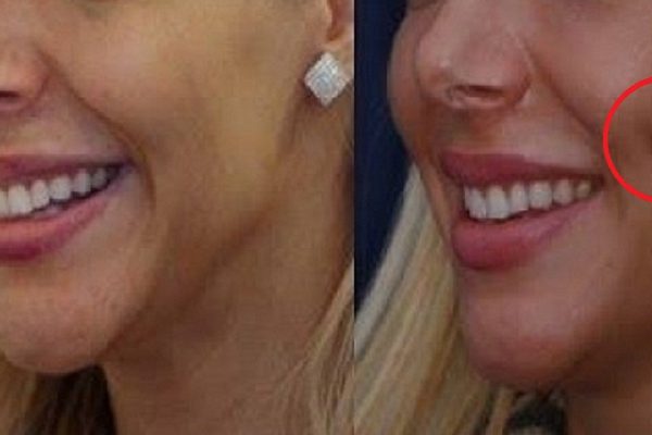 Если у тебя есть ямочки на щеках, тебе несказанно повезло! И вот почему…