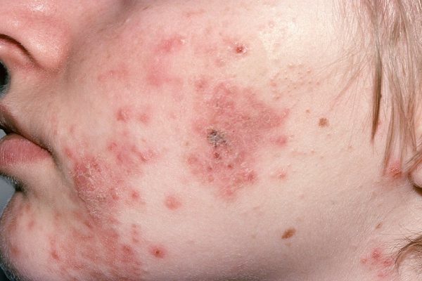 Severe cystic acne.